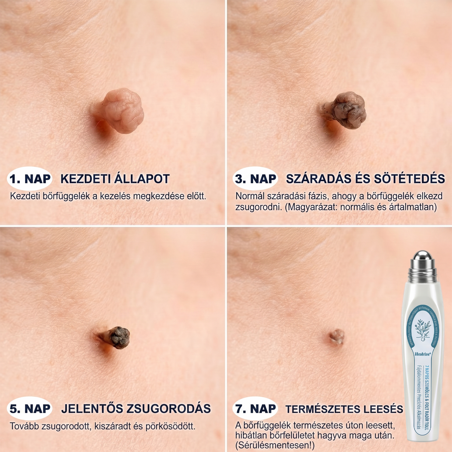✅👨‍🦳𝐇𝐢𝐯𝐚𝐭𝐚𝐥𝐨𝐬 𝐦á𝐫𝐤𝐚𝐛𝐨𝐥𝐭  𝐇𝐞𝐚𝐥𝐫𝐢𝐳𝐞®   𝟕 𝐍𝐚𝐩𝐨𝐬 𝐁ő𝐫𝐤𝐢𝐧ö𝐯é𝐬- é𝐬 𝐅𝐨𝐥𝐭𝐫𝐚𝐝í𝐫(Fájdalommentes, nyommentes roll-on)