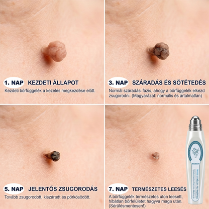 ✅👨‍🦳𝐇𝐢𝐯𝐚𝐭𝐚𝐥𝐨𝐬 𝐦á𝐫𝐤𝐚𝐛𝐨𝐥𝐭  𝐇𝐞𝐚𝐥𝐫𝐢𝐳𝐞®   𝟕 𝐍𝐚𝐩𝐨𝐬 𝐁ő𝐫𝐤𝐢𝐧ö𝐯é𝐬- é𝐬 𝐅𝐨𝐥𝐭𝐫𝐚𝐝í𝐫(Fájdalommentes, nyommentes roll-on)