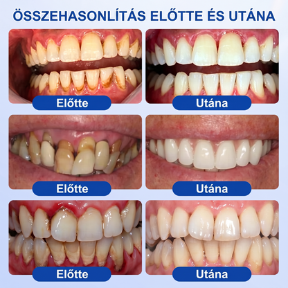 Zoencgz® 👅🍹 Antibakteriális ínyregeneráló gél | Látható eredmények már 7 nap alatt